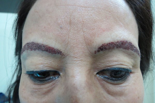 Eyebrow Hair Transplant In Delhi Eyebrow Restoration Cost And