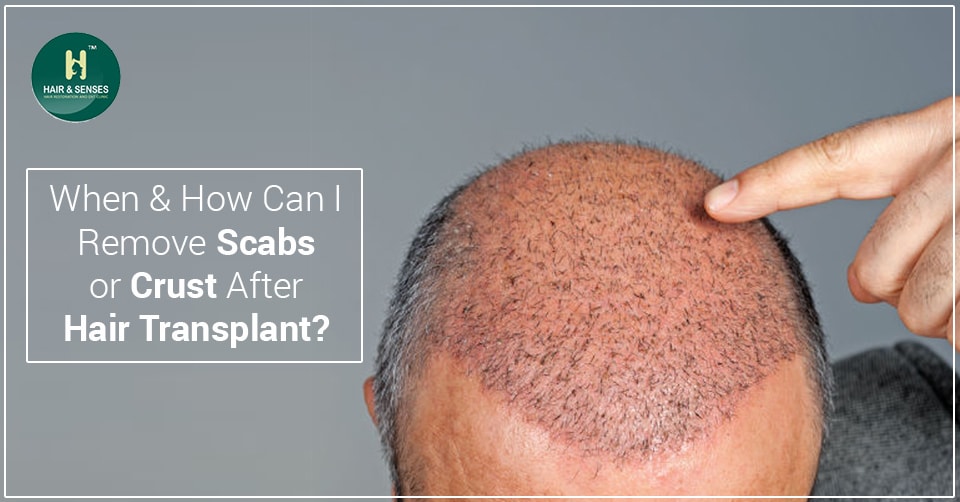 When & how can I remove scabs or crust after hair transplant