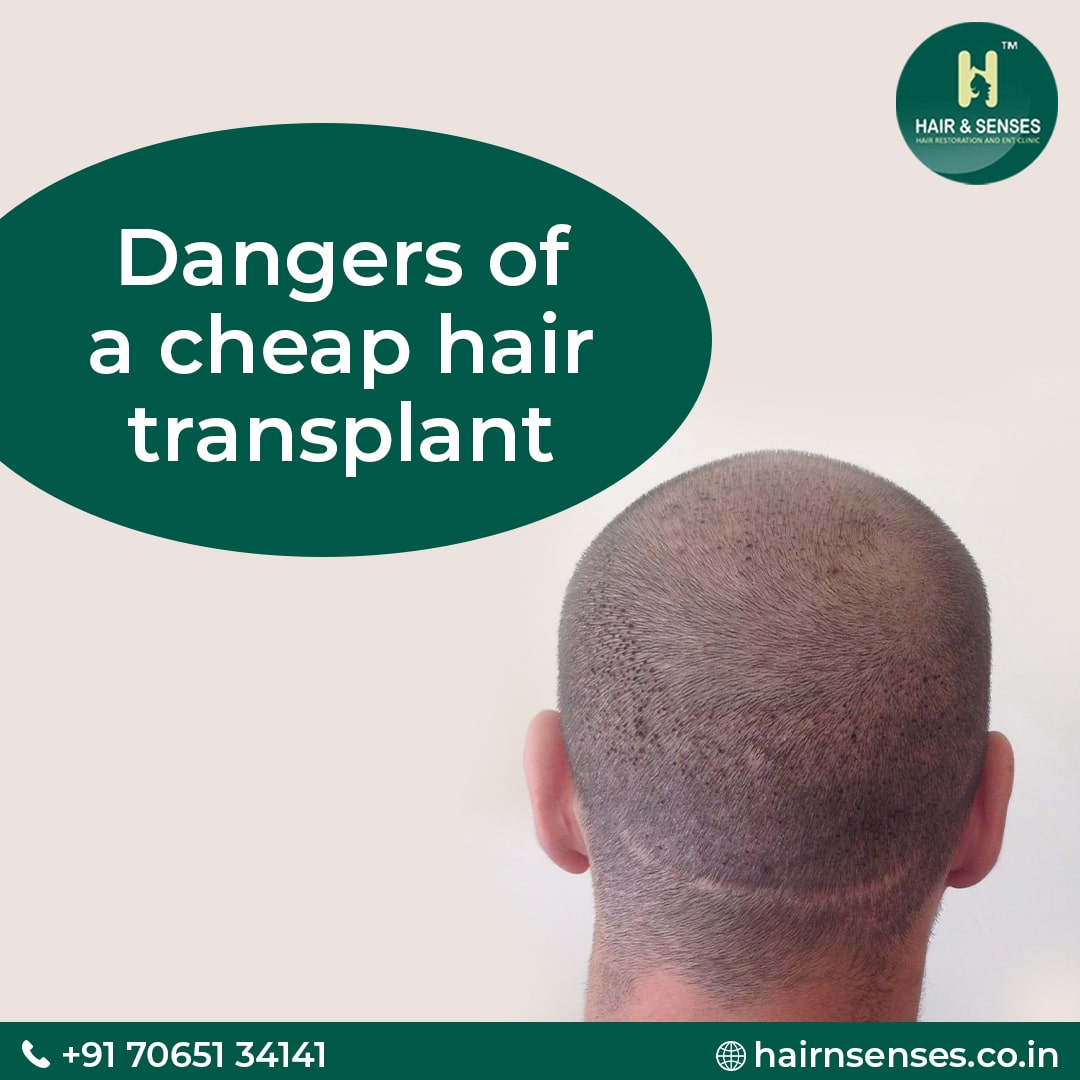 Hair Transplant Gone Wrong  A Look at the Biggest Risks