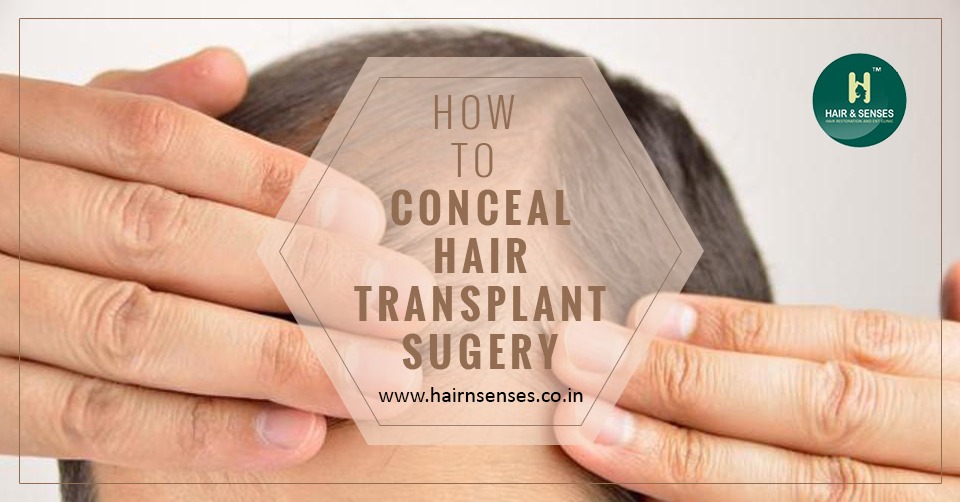 Concealing Hair Transplant