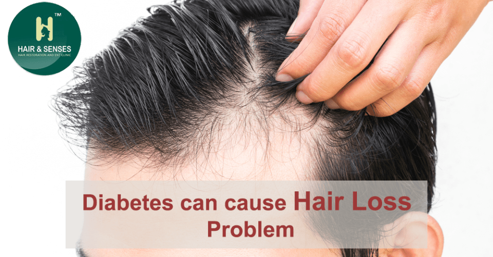 Hair loss and diabetes