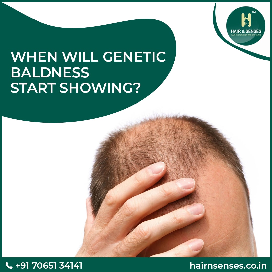 How is Baldness Genetically Inherited  MyDCSI