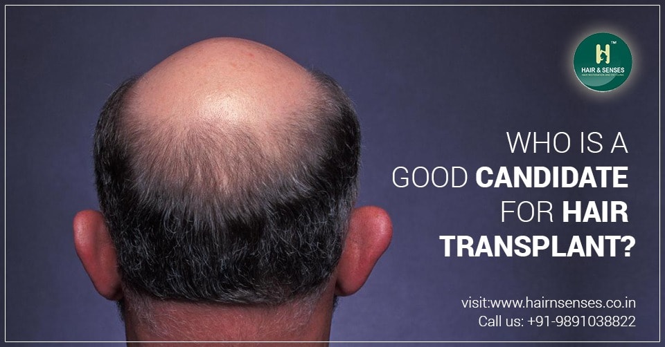 Hair Transplant Candidate