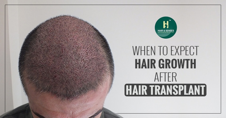 Hair Growth after Hair Transplant
