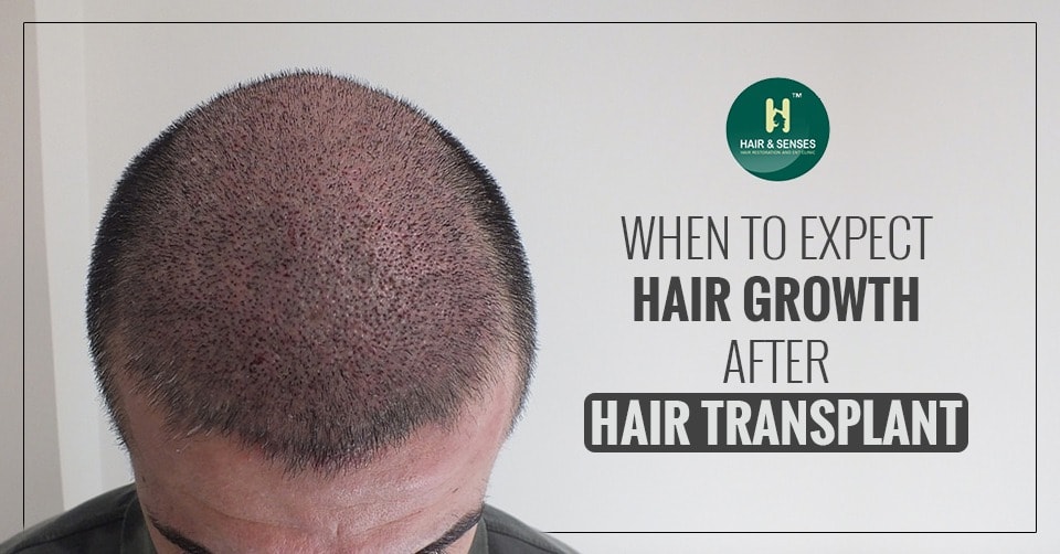 Hair falling out  Shedding after hair transplant NYC