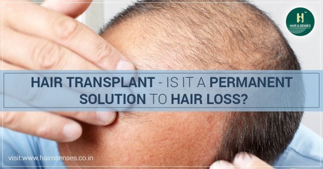 Hair Transplant Permanent Solution