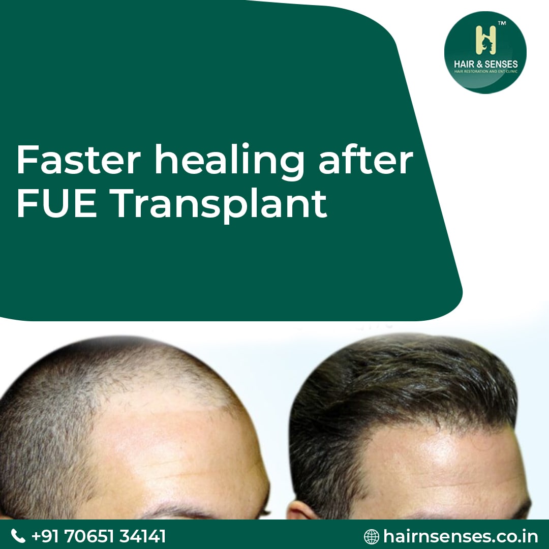 Hair Transplant Tips