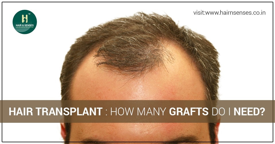 Hair transplant: How many grafts do I need?