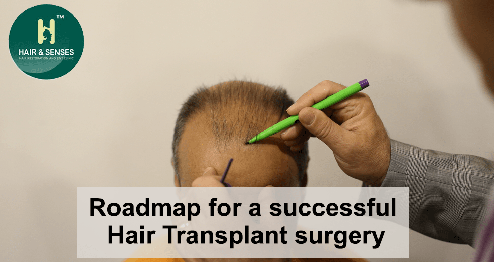 Roadmap for a successful hair transplant surgery