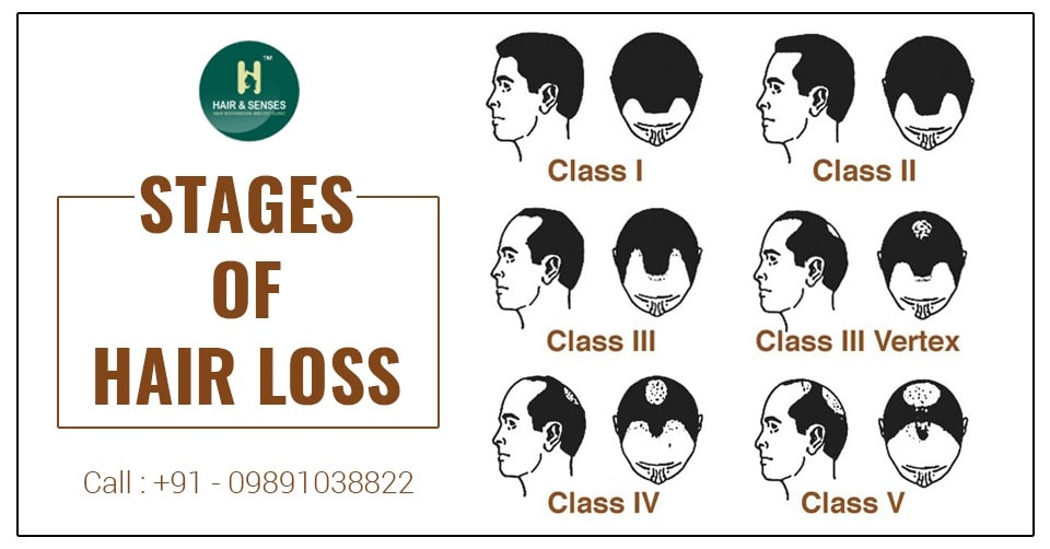 Stages of Hair Loss | Hair Loss Article