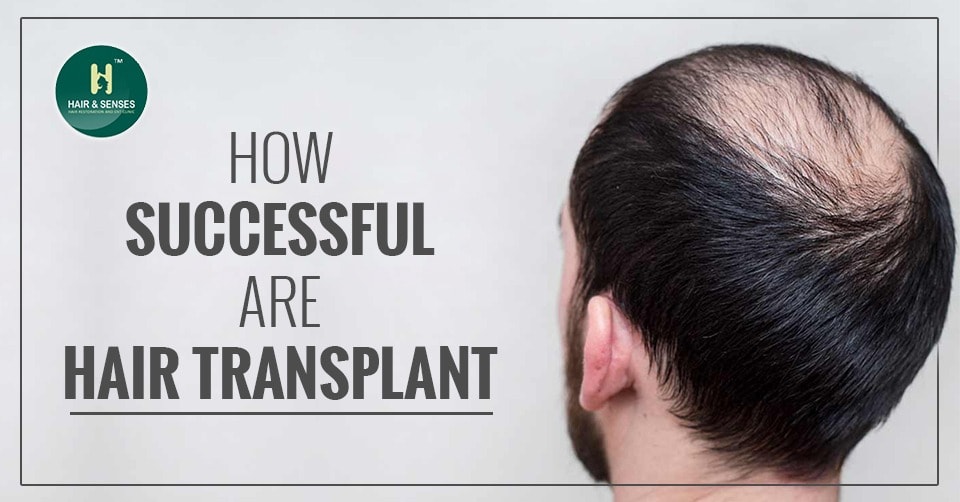 Successful Hair Transplant