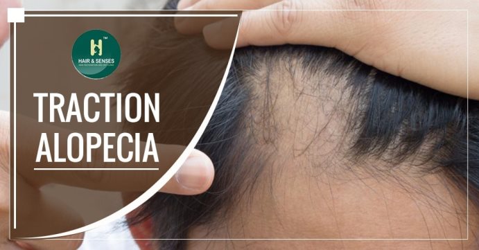 Traction Alopecia