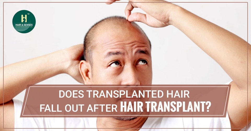 Hair fall after transplant