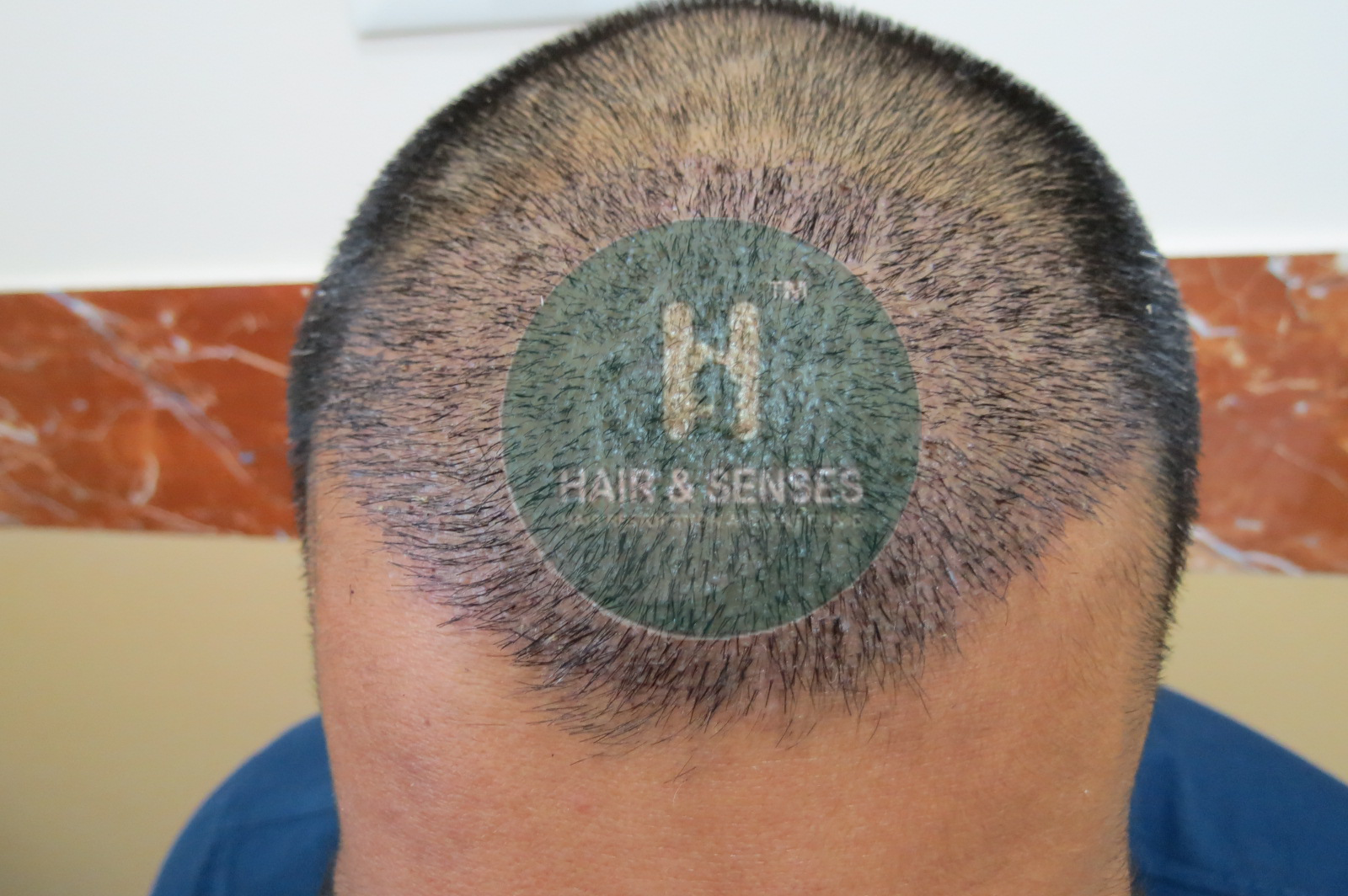 Hair Transplant Case Study with 2190 Grafts in 28 Years Old Guy Hair Transplant Case Study with 2190 Grafts in 28 Years Old Guy