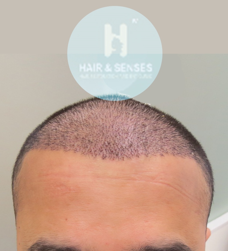 Hair Transplant Case Studies by Hair & Senses | Hair Transplant Case Study Results Before After Hair Transplant Case Studies by Hair & Senses | Hair Transplant Case Study Results Before After