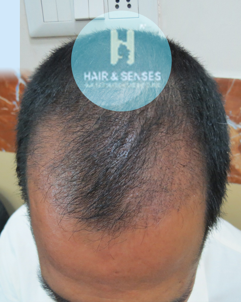 New Roots Hair Transplant Center - Pre shedding phase - Today we will  discuss regarding pre shedding phase which lasts from 7th day to 31 days of hair  Transplant. Experts from New