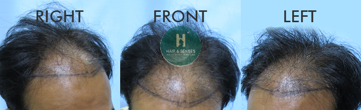 Hair Transplant Case Study with 3500 Grafts in 43 Years Aged Entrepreneur | Hair  Transplant Case Study