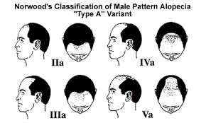 norwood classification