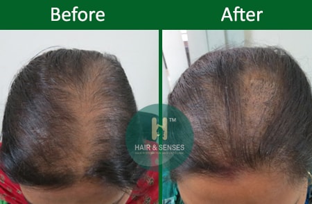 Female Hair Transplant Treatment and Cost  HFHG Blog