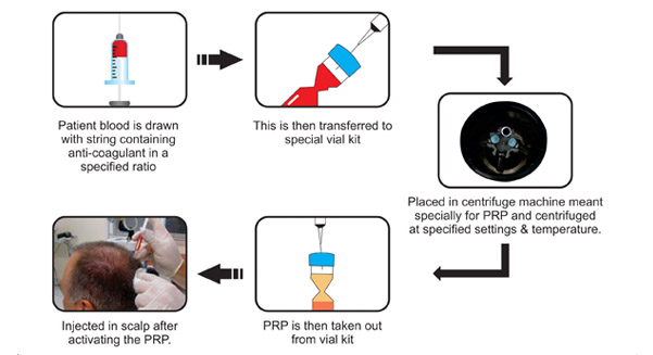 PRP for Hair Loss