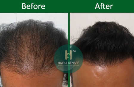 Repair Hair Transplant