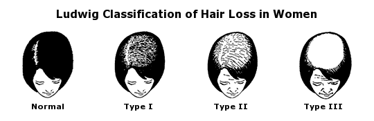 Ego Wellness Tips : FEMALE PATTERN HAIRLOSS OR LUDWIG CLASSIFICATION